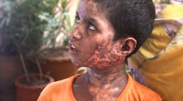 FIMB - slave boy acid burns