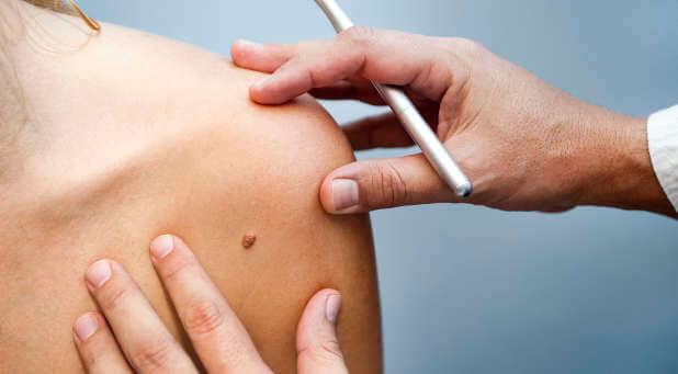 Melanoma is responsible for about 9,000 deaths per year in the U.S.